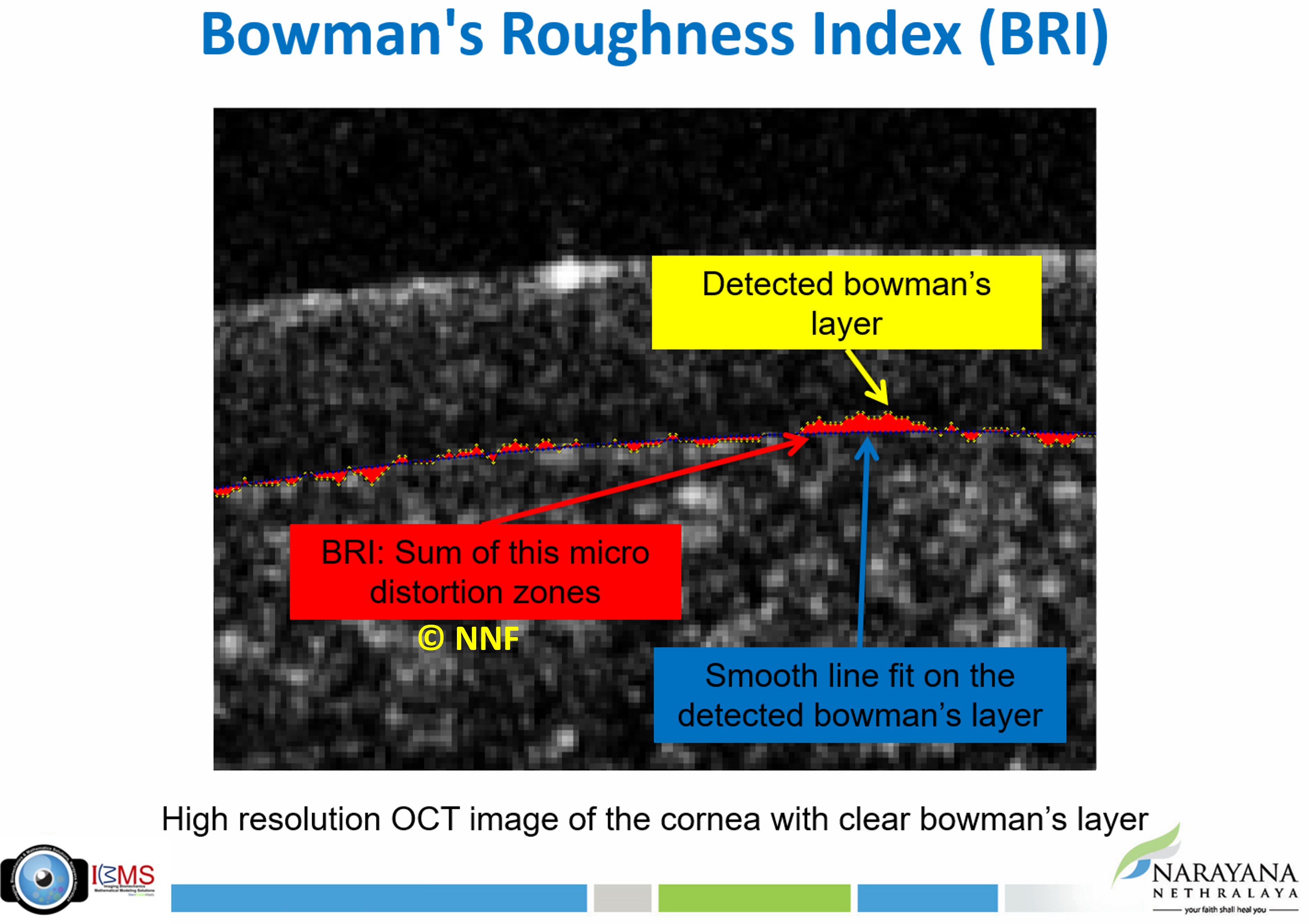 Bowman's Roughness Index (BRI)