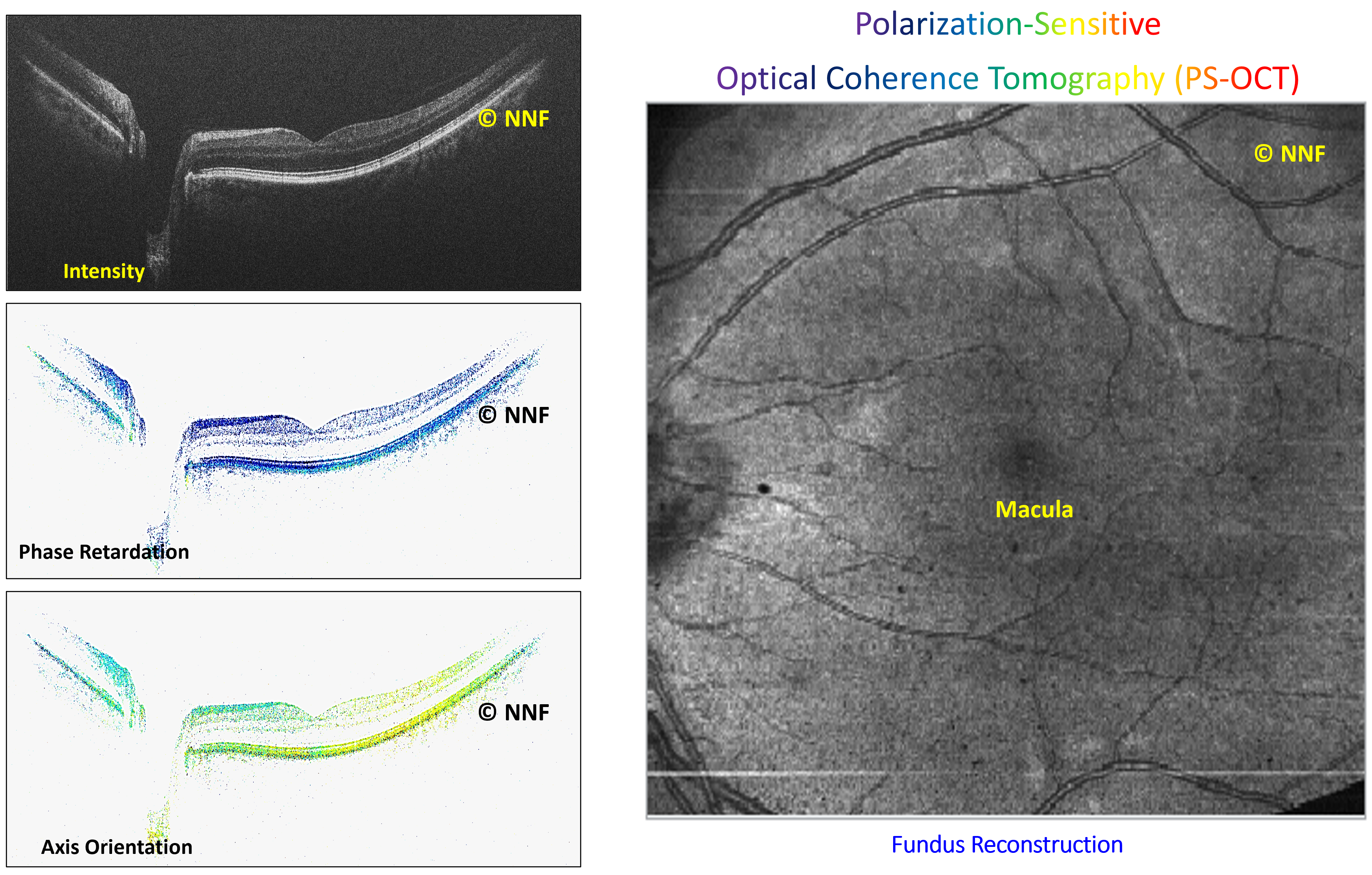 PS-OCT_Retina